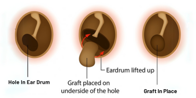 Tympanoplasty