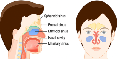 sinus solution - microcare ent hospital