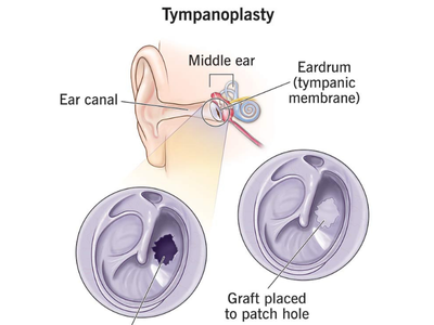 Tympanoplasty surgery in Hyderabad – eardrum repair with graft placement at Microcare ENT Hospital