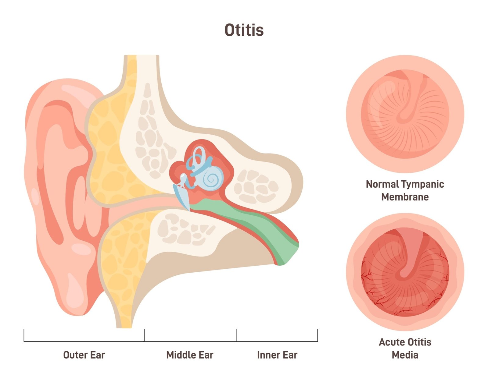 Medical illustration showing outer, middle, and inner ear anatomy with comparison between a normal tympanic membrane and acute otitis media.
