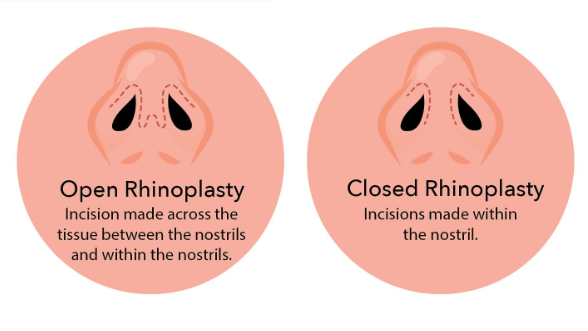 Closed vs open rhinoplasty explained by ENT surgeon at MicroCare ENT Hospital, Hyderabad (KPHB, Kukatpally), Telangana