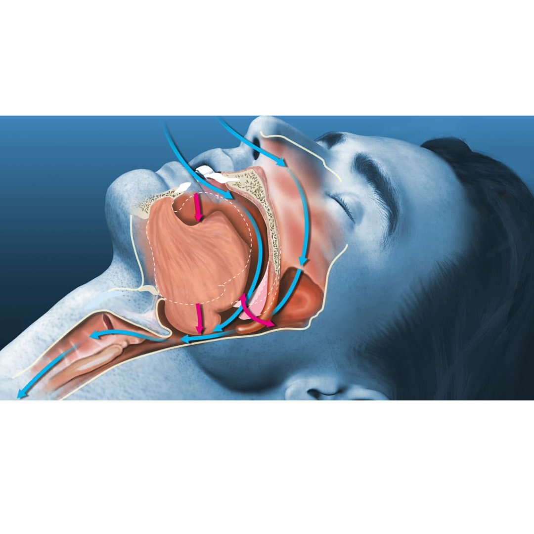 Snoring risks and sleep apnea warning signs explained by ENT specialist at MicroCare ENT Hospital Hyderabad Telangana