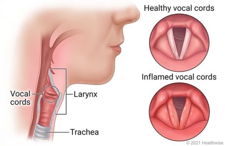 Laryngitis treatment and voice care by ENT specialists at MicroCare ENT Hospital Hyderabad Telangana