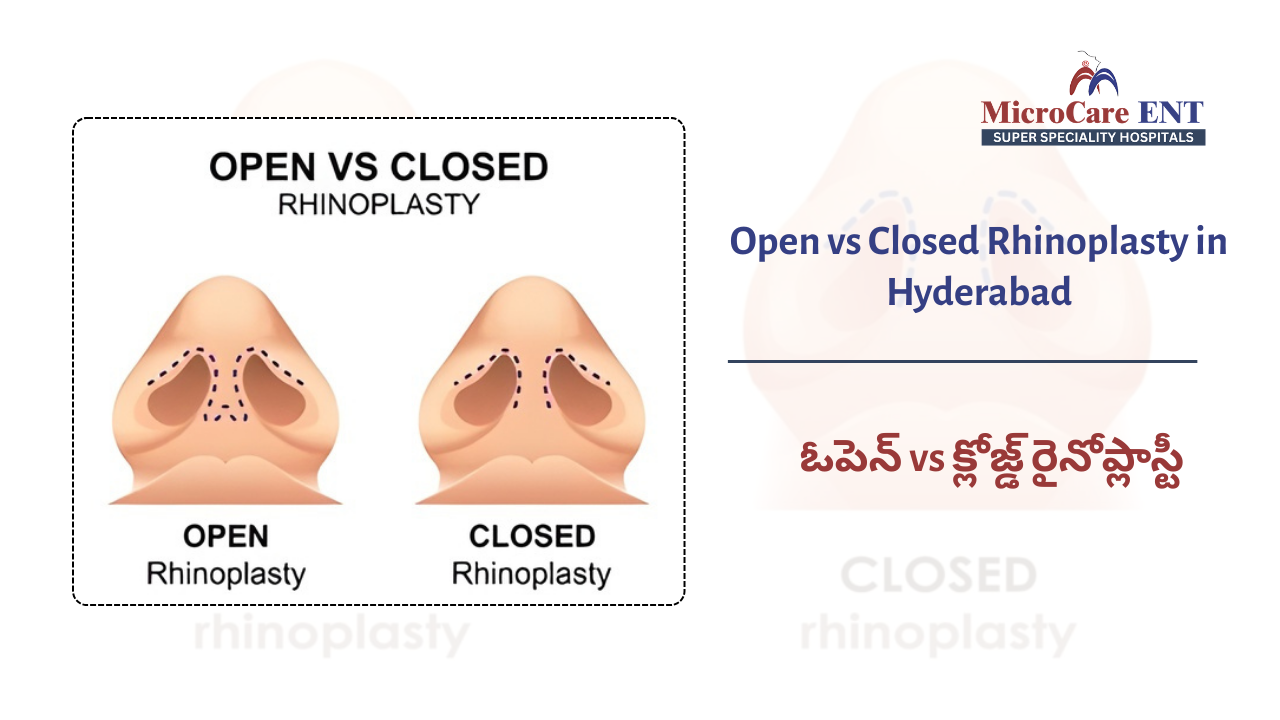 open vs closed rhinoplasty difference showing incision techniques at Microcare ENT Hospitals Hyderabad
