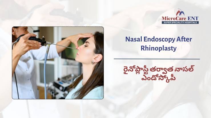 Doctor performing a nasal endoscopy on a patient after rhinoplasty to evaluate healing and nasal function at MicroCare ENT Hospital in Hyderabad.