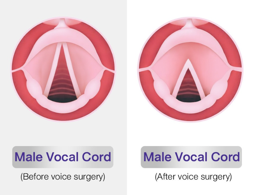 female to male voice surgery voice masculinization Hyderabad