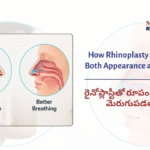 How Rhinoplasty Can&hellip;