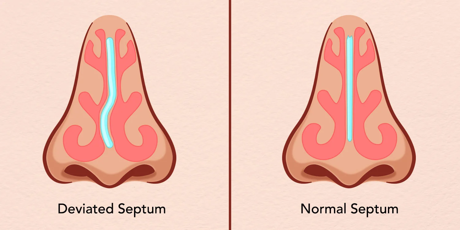 deviated septum causing blocked nose and breathing issues