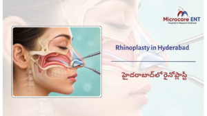 Rhinoplasty in Hyderabad | MicroCare ENT Super Speciality