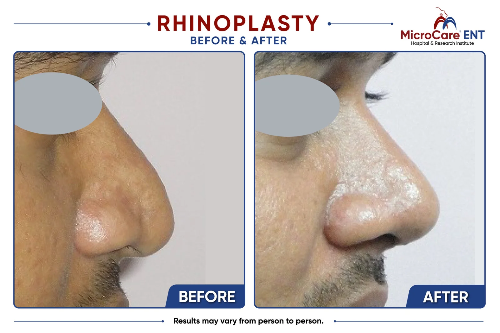 Prof. Dr. Sriprakash Vinnakota providing rhinoplasty consultation at MicroCare ENT Hospital in Hyderabad